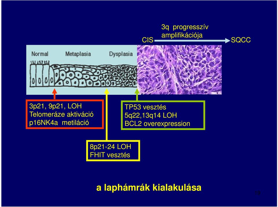 TP53 vesztés 5q22,13q14 LOH BCL2 overexpression