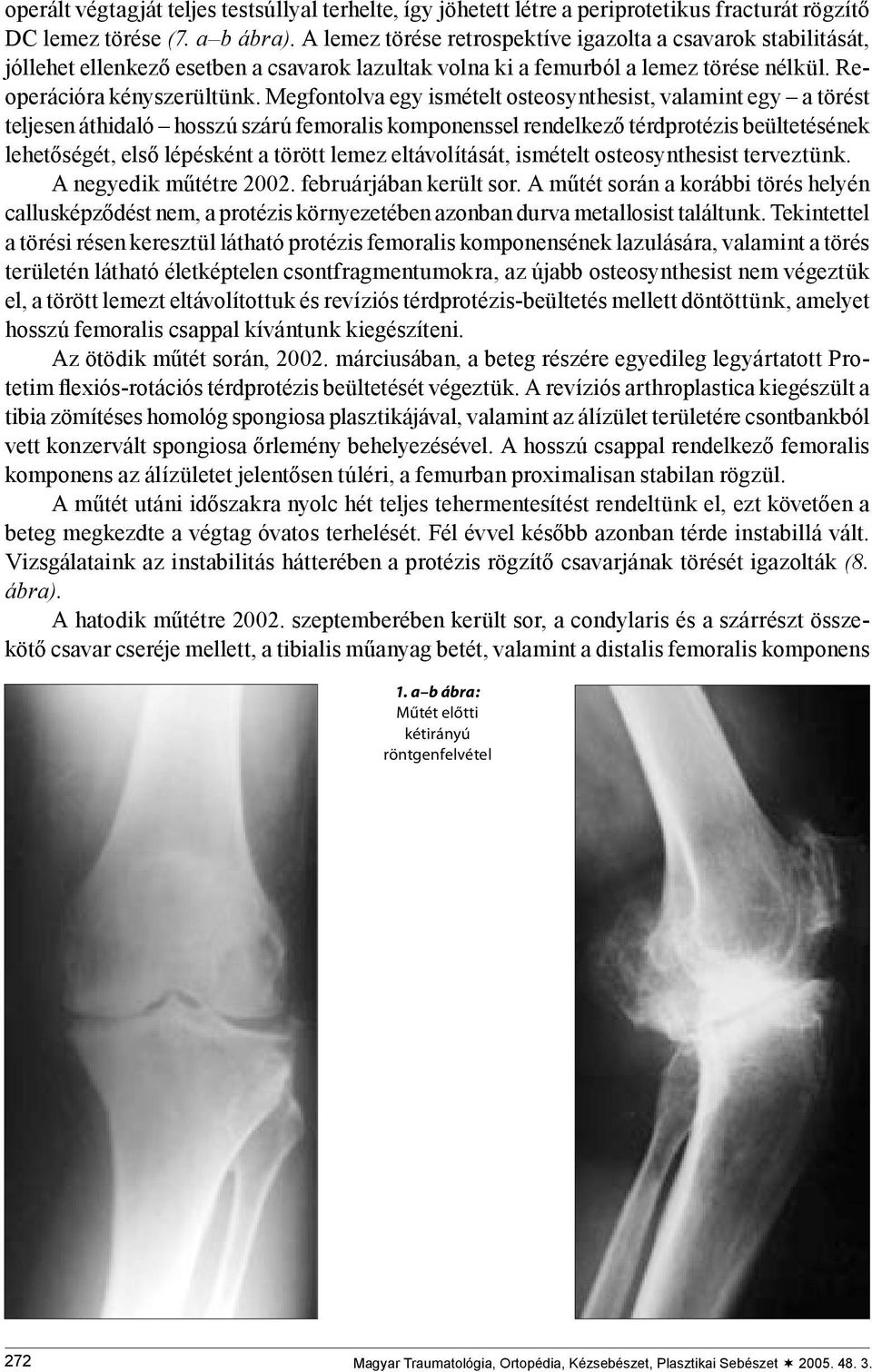 Megfontolva egy ismételt osteosynthesist, valamint egy a törést teljesen áthidaló hosszú szárú femoralis komponenssel rendelkező térdprotézis beültetésének lehetőségét, első lépésként a törött lemez