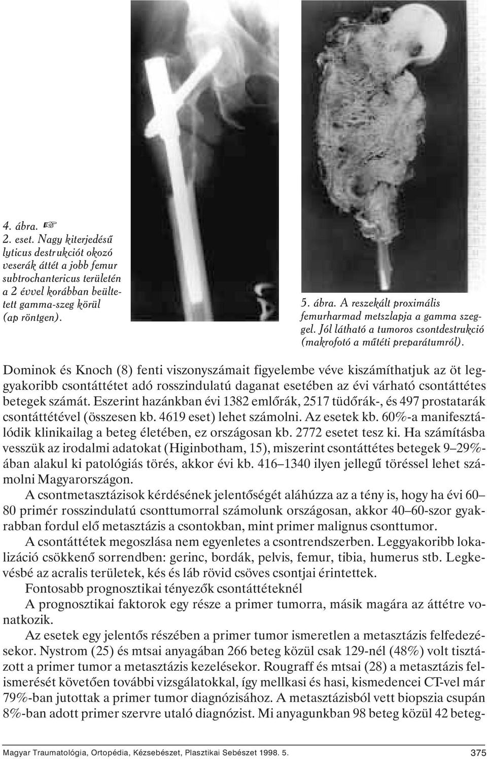 Dominok és Knoch (8) fenti viszonyszámait figyelembe véve kiszámíthatjuk az öt leggyakoribb csontáttétet adó rosszindulatú daganat esetében az évi várható csontáttétes betegek számát.