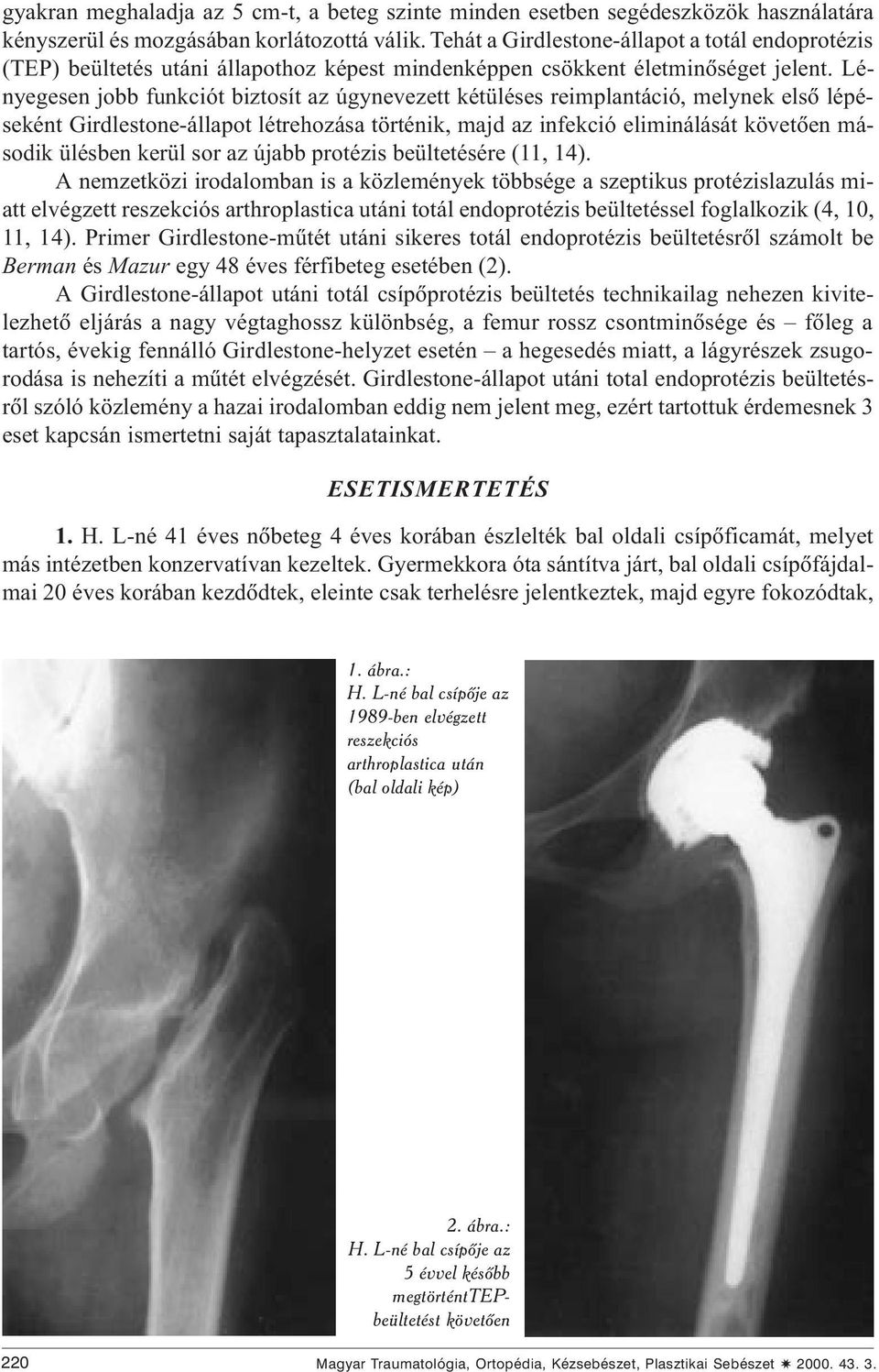 Lényegesen jobb funkciót biztosít az úgynevezett kétüléses reimplantáció, melynek elsõ lépéseként Girdlestone-állapot létrehozása történik, majd az infekció eliminálását követõen második ülésben