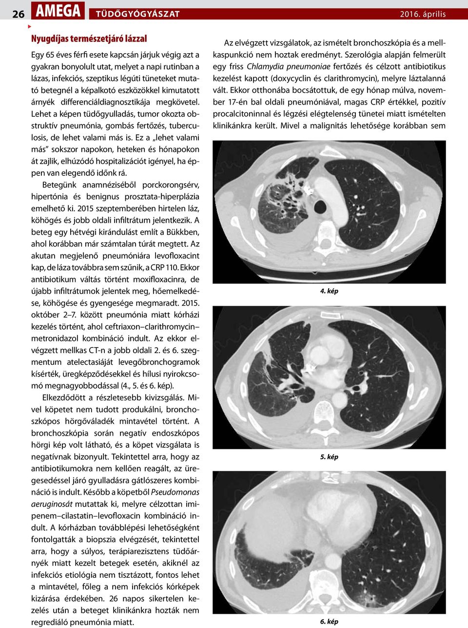 Lehet a képen tüdőgyulladás, tumor okozta obstruktív pneumónia, gombás fertőzés, tuberculosis, de lehet valami más is.