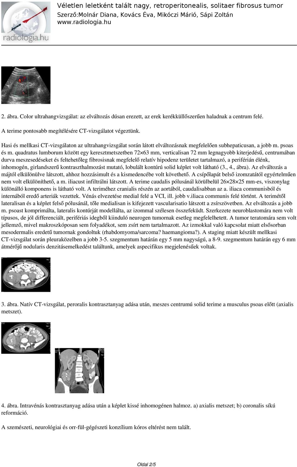 quadratus lumborum között egy keresztmetszetben 72 63 mm, verticalisan 72 mm legnagyobb kiterjedésű, centrumában durva meszesedéseket és feltehetőleg fibrosisnak megfelelő relatív hipodenz területet
