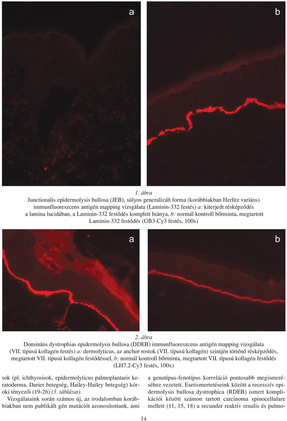 lamina lucidában, a Laminin-332 festôdés komplett hiánya, b: normál kontroll bôrminta, megtartott Laminin-332 festôdés (GB3-Cy3 festés, 100x) a b 2.