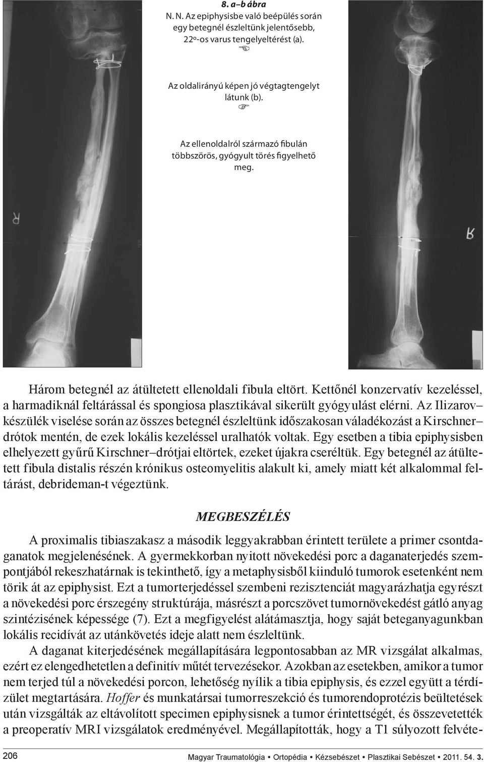 Kettőnél konzervatív kezeléssel, a harmadiknál feltárással és spongiosa plasztikával sikerült gyógyulást elérni.