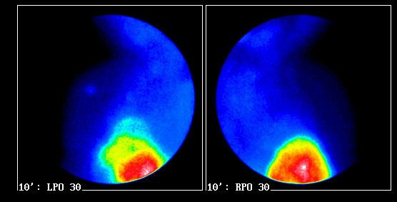 Példák. Agydaganat: Spongioblastoma: 99mTc-MIBI agyi SPECT-el PAJZSMIRIGY TUMOROK Differenciáltak (papilláris, follikuláris) 99mTc-pertech p.m. szcintigráfia 99mTc-MIBI 131I-NaI /egésztest/ Beépülési mechanizmus: Lipofil kation transzport.