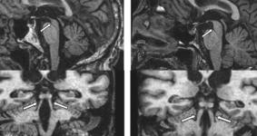 ALZHEIMER-KÓR: SCHELTENS SKÁLÁJA VASCULARIS ELVÁLTOZÁSOK KIMUTATÁSA: CADASIL Valk J, Barkhof F, Scheltens P, 2002 Fokális atrophia