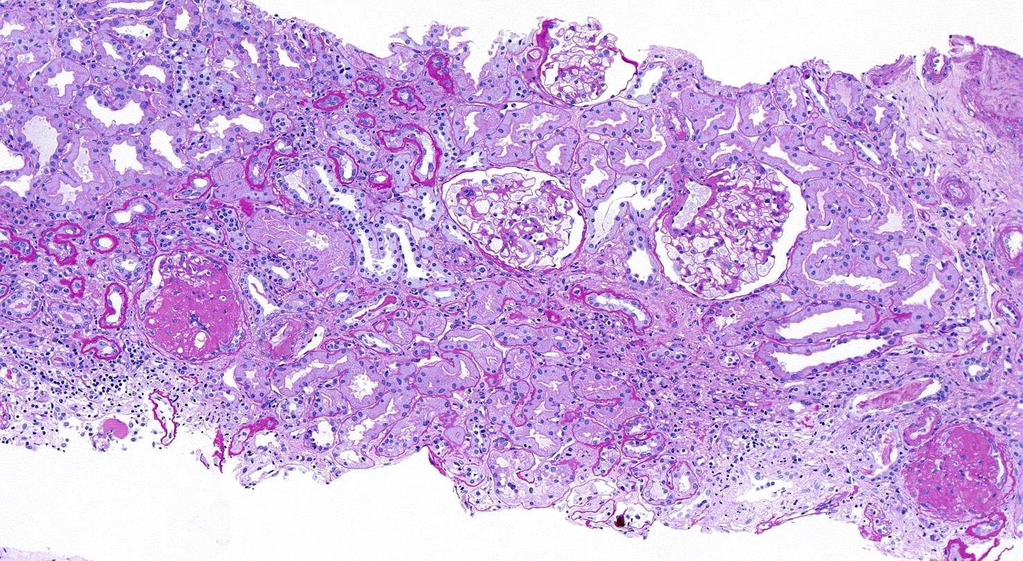 FSGS lézió: három glomerulus