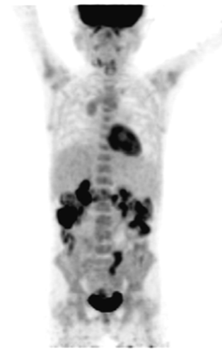 Eset 4. 17 év, hallászavar miatt kivizsgálás, Schminke tip. cc. Irradiatio elıtt PET/CT Nasopharingealis tu. Mko nyaki met. nycs. Távoli met. nincs. Eset 5. Irradiatio és chemo után th.