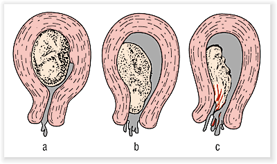 Abortus spontaneus III. Stádiumai: ab. imminens ab.