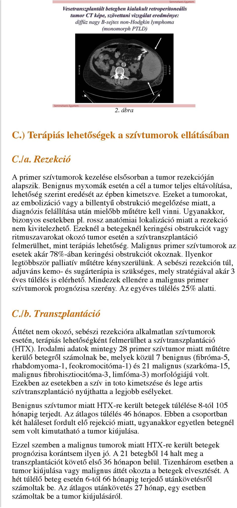 Ezeket a tumorokat, az embolizáció vagy a billentyű obstrukció megelőzése miatt, a diagnózis felállítása után mielőbb műtétre kell vinni. Ugyanakkor, bizonyos esetekben pl.