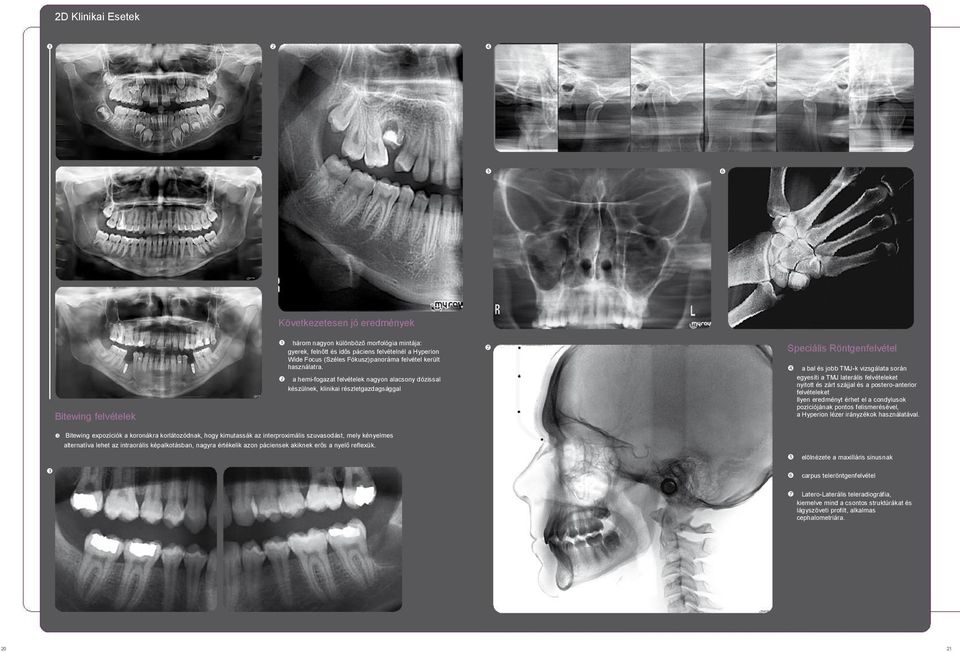 a hemi-fogazat felvételek nagyon alacsony dózissal készülnek, klinikai részletgazdagsággal Speciális Röntgenfelvétel a bal és jobb TMJ-k vizsgálata során egyesíti a TMJ laterális felvételeket nyitott