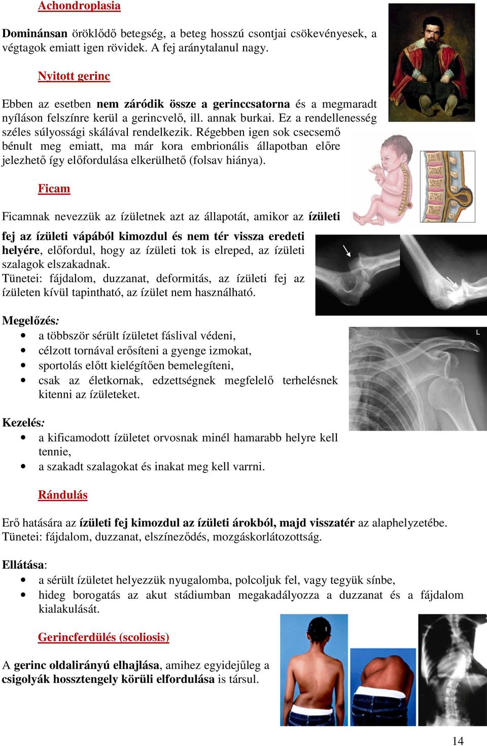 Régebben igen sok csecsemő bénult meg emiatt, ma már kora embrionális állapotban előre jelezhető így előfordulása elkerülhető (folsav hiánya).