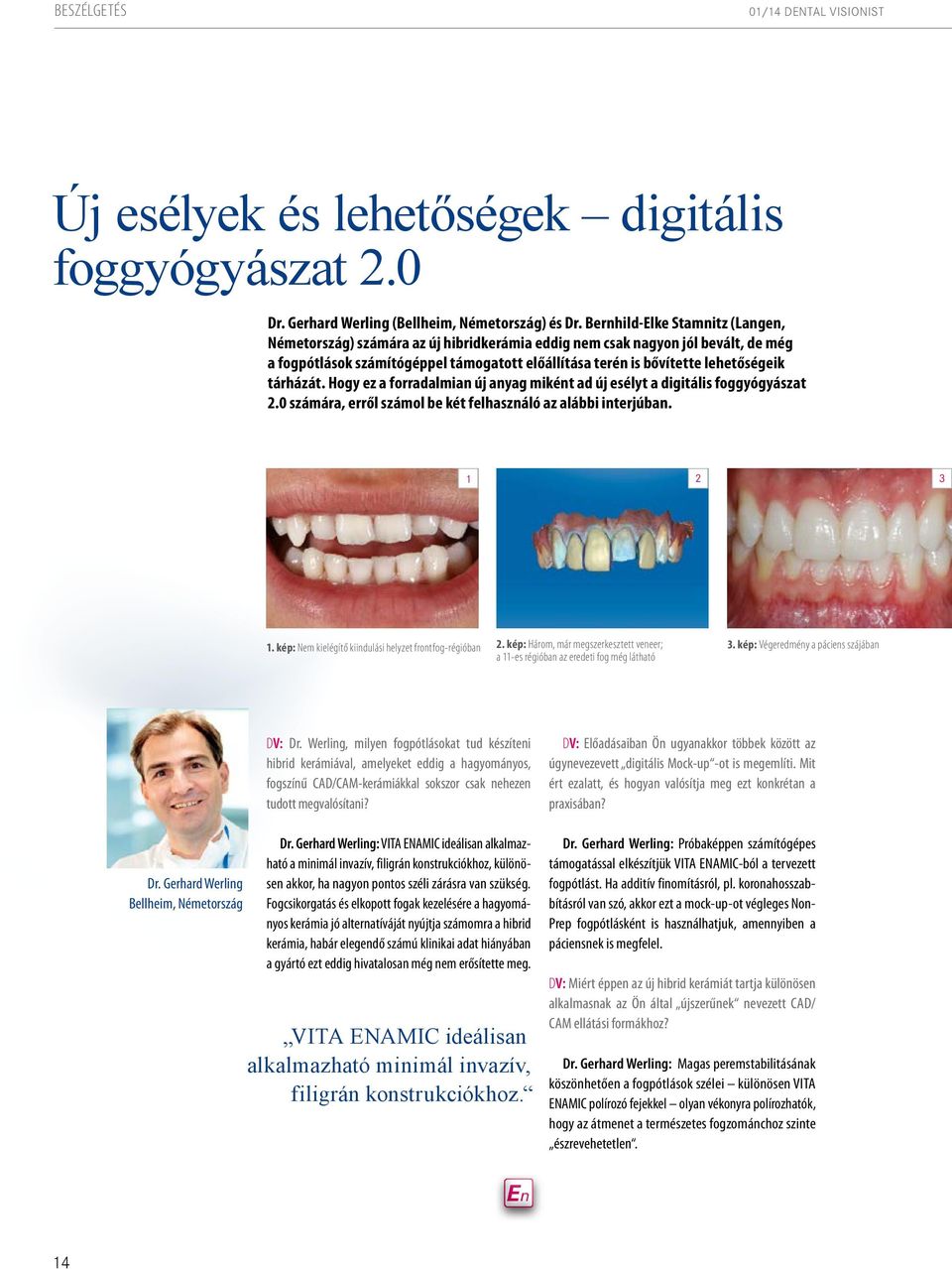 tárházát. Hogy ez a forradalmian új anyag miként ad új esélyt a digitális foggyógyászat 2.0 számára, erről számol be két felhasználó az alábbi interjúban. 1 2 3 1.