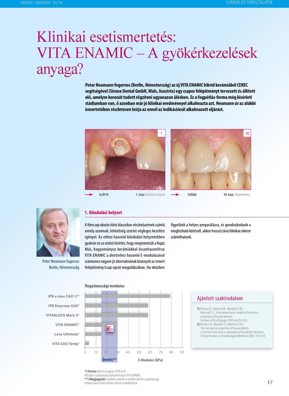 koronát tudott rögzíteni ugyanazon ülésben. Ez a fogpótlás-forma még kisérleti stádiumban van, ő azonban már jó klinikai eredménnyel alkalmazta azt.