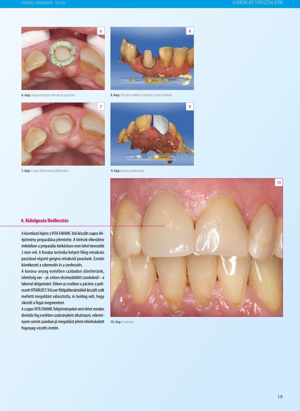 A törések elkerülése érdekében a preparálás körkörösen nem lehet kevesebb 2 mm-nél. A fonalas technika helyett főleg retrakciós pasztával végzett gingiva retrakciót javaslunk.