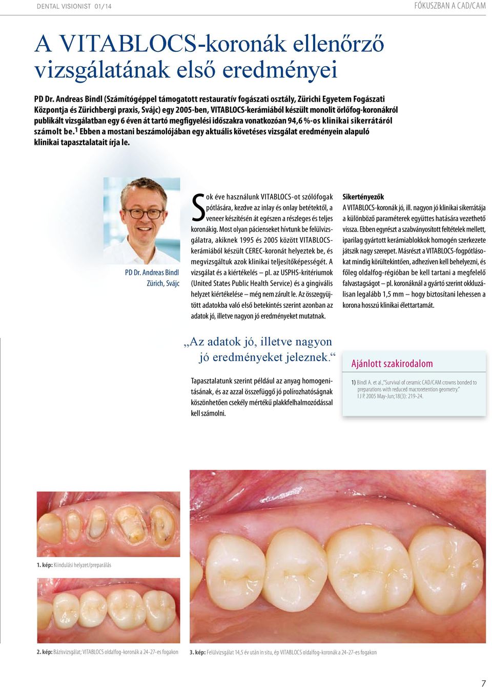 örlőfog-koronákról publikált vizsgálatban egy 6 éven át tartó megfigyelési időszakra vonatkozóan 94,6 %-os klinikai sikerrátáról számolt be.