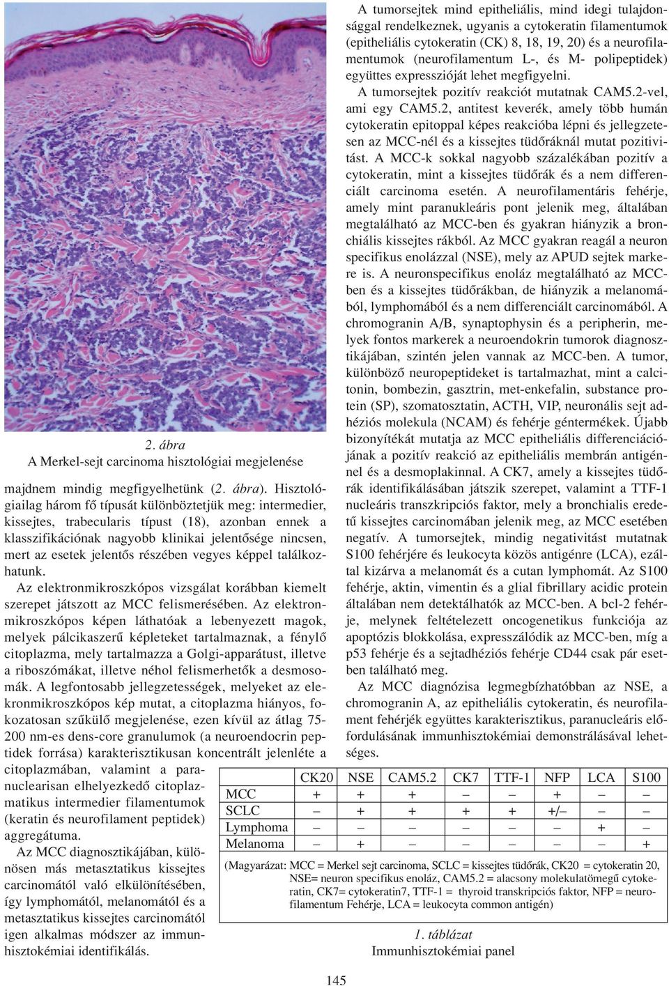 2, antitest keverék, amely több humán cytokeratin epitoppal képes reakcióba lépni és jellegzetesen az MCC-nél és a kissejtes tüdôráknál mutat pozitivitást.