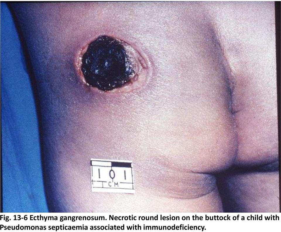 buttock of a child with Pseudomonas