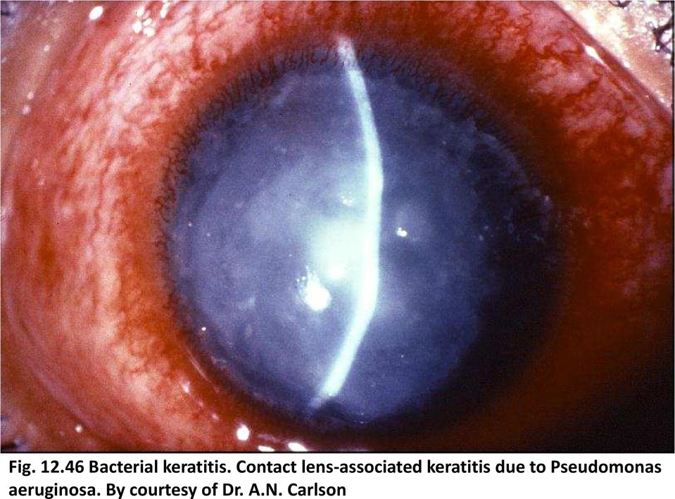 keratitis due to Pseudomonas