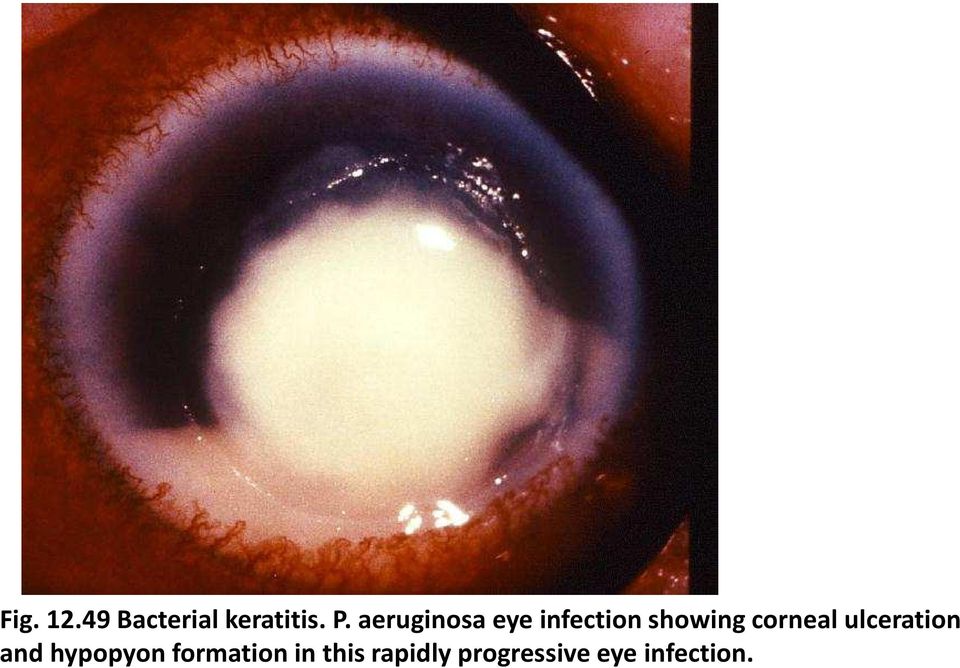 corneal ulceration and hypopyon