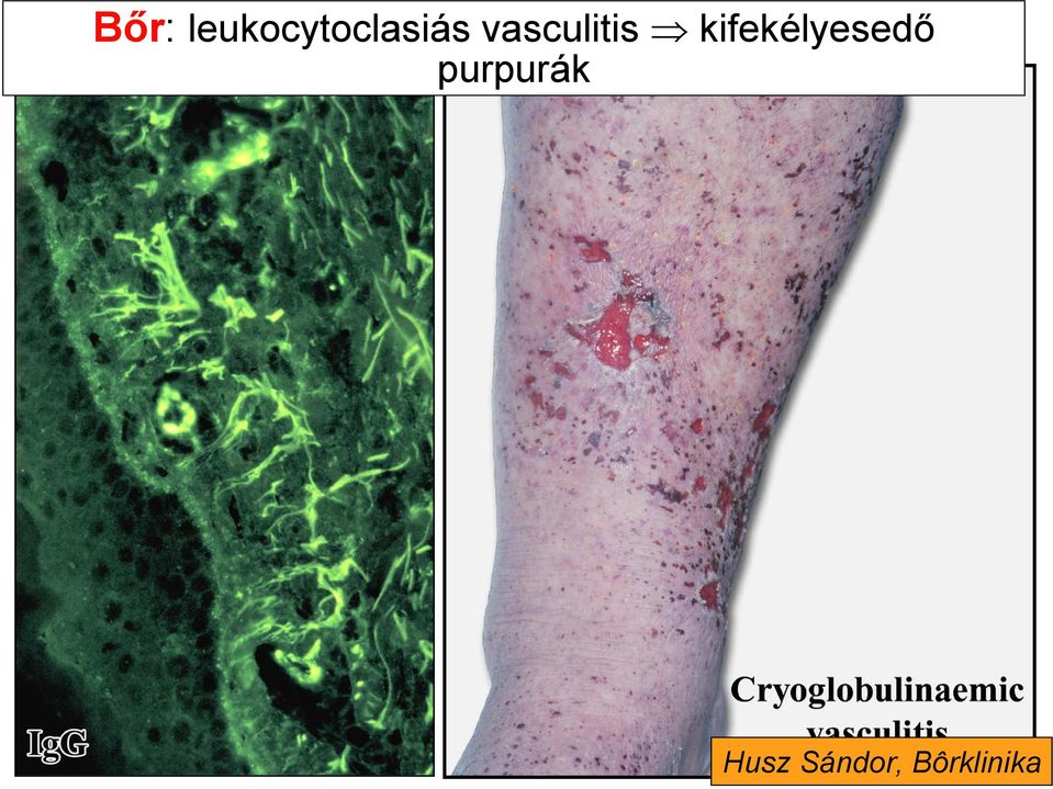 vasculitis