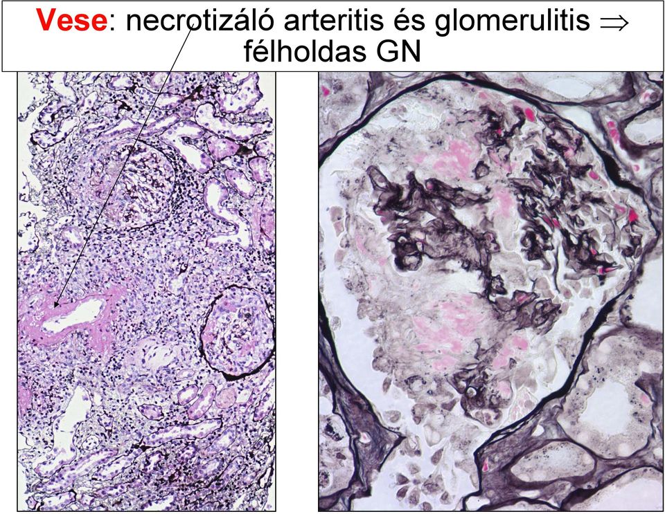arteritis és