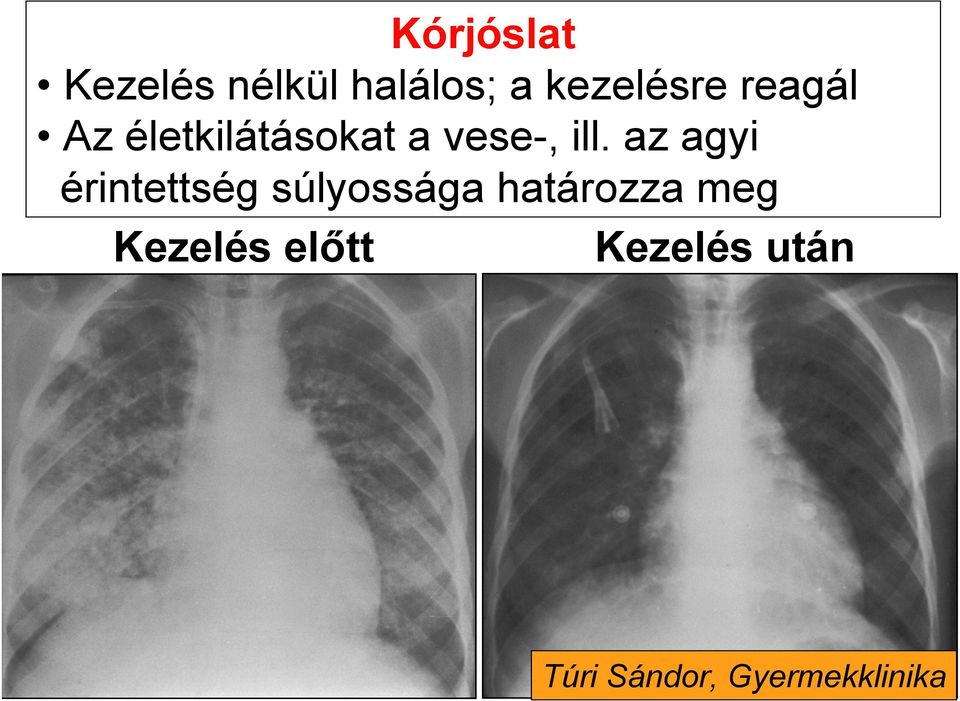 az agyi érintettség súlyossága határozza meg