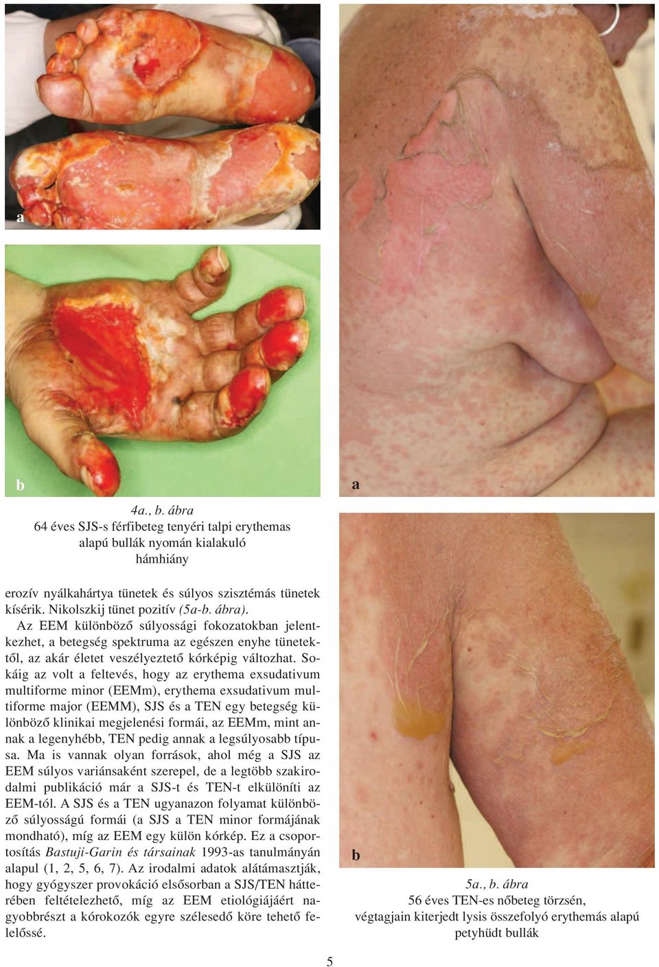 Sokáig az volt a feltevés, hogy az erythema exsudativum multiforme minor (EEMm), erythema exsudativum multiforme major (EEMM), SJS és a TEN egy betegség különbözô klinikai megjelenési formái, az