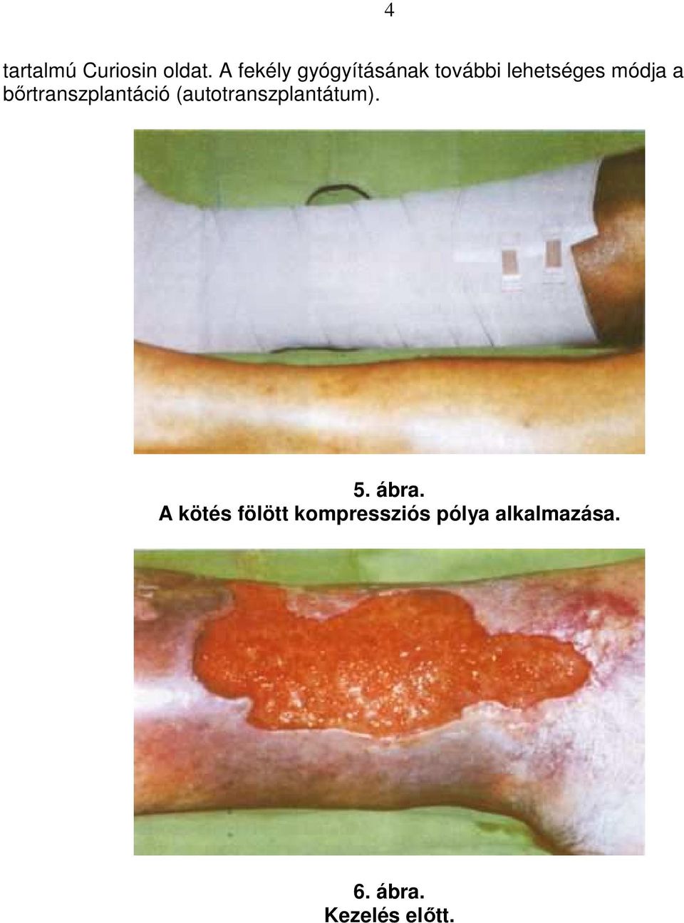 bırtranszplantáció (autotranszplantátum). 5. ábra.