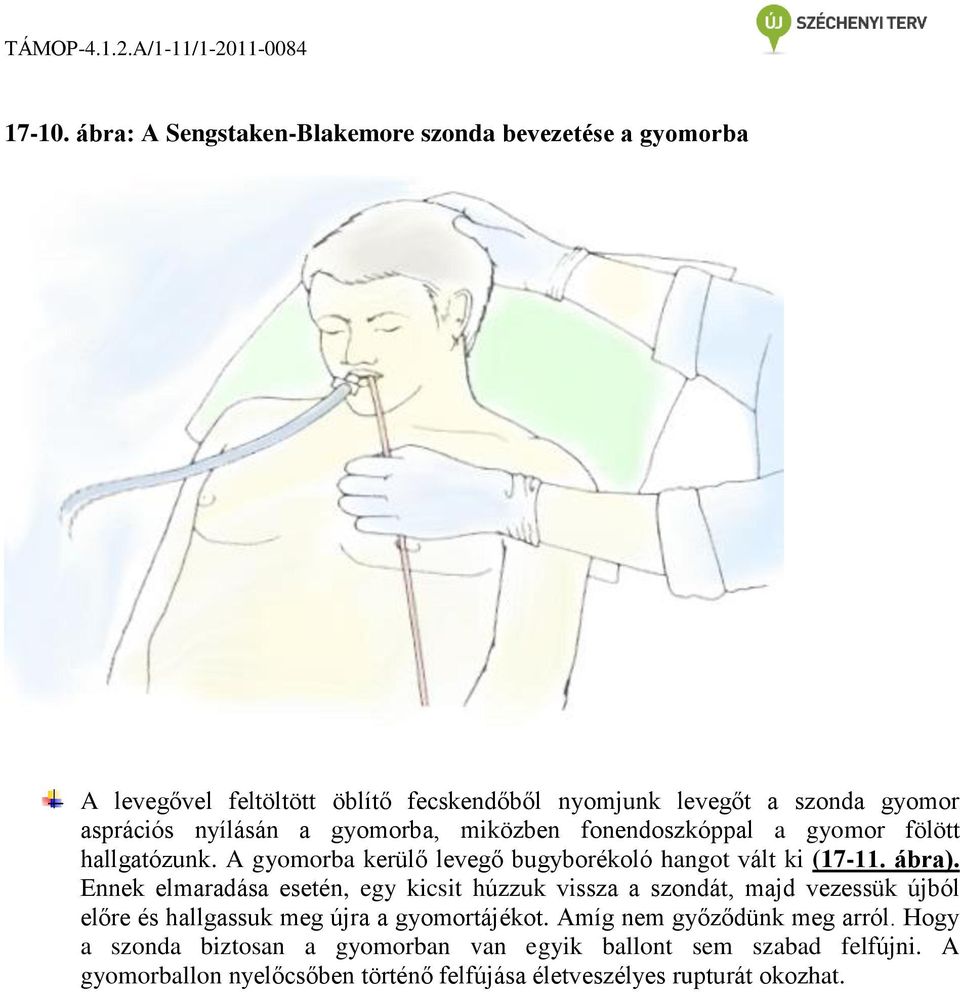 nyílásán a gyomorba, miközben fonendoszkóppal a gyomor fölött hallgatózunk. A gyomorba kerülő levegő bugyborékoló hangot vált ki (17-11. ábra).