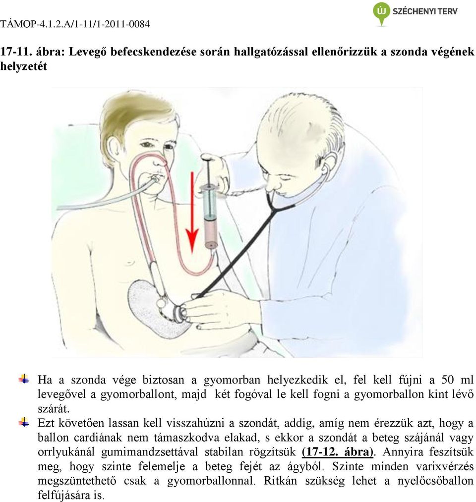 levegővel a gyomorballont, majd két fogóval le kell fogni a gyomorballon kint lévő szárát.