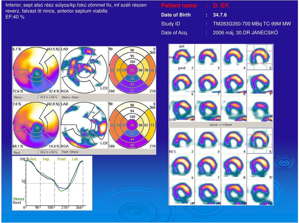 anterior septum viabilis EF:40 % Patient name : D. GY.