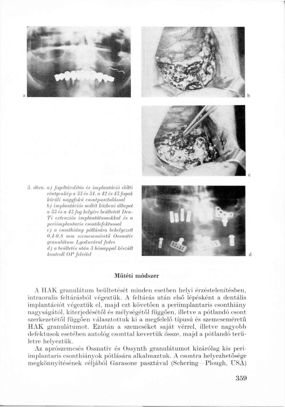 extenziós implantátumokkal és a periimplantaris csontdefektussal c) a csonthiány pótlására behelyezett 0,4-0,8 mm szemcseméretű Ossnativ granulátum Lyodurával fedve d) a beültetés után 3 hónappal