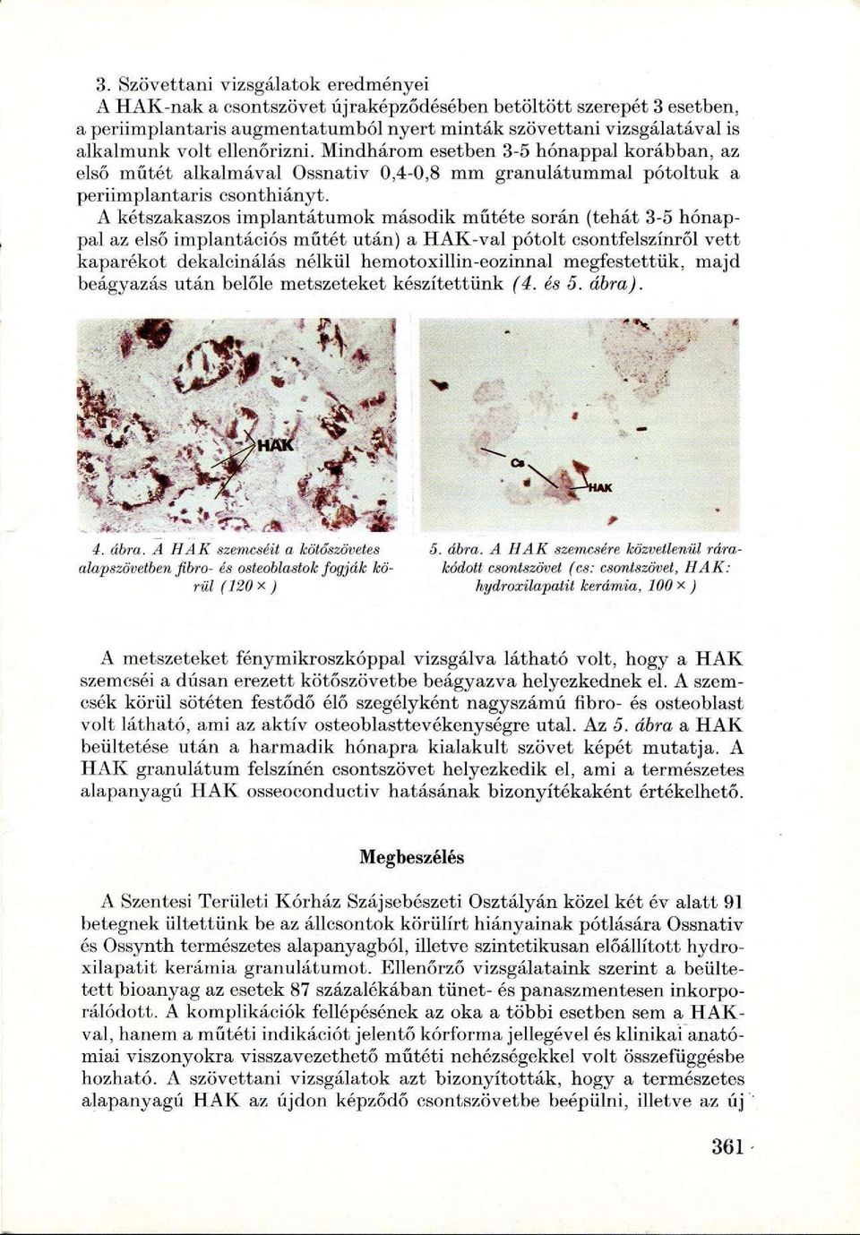 A kétszakaszos implantátumok második műtéte során (tehát 3-5 hónappal az első implantációs műtét után) a HAK-val pótolt csontfelszínről vett kaparékot dekalcinálás nélkül hemotoxillin-eozinnal