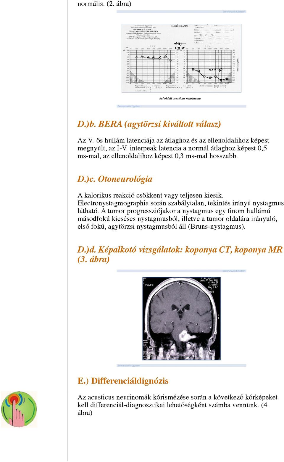 Electronystagmographia során szabálytalan, tekintés irányú nystagmus látható.