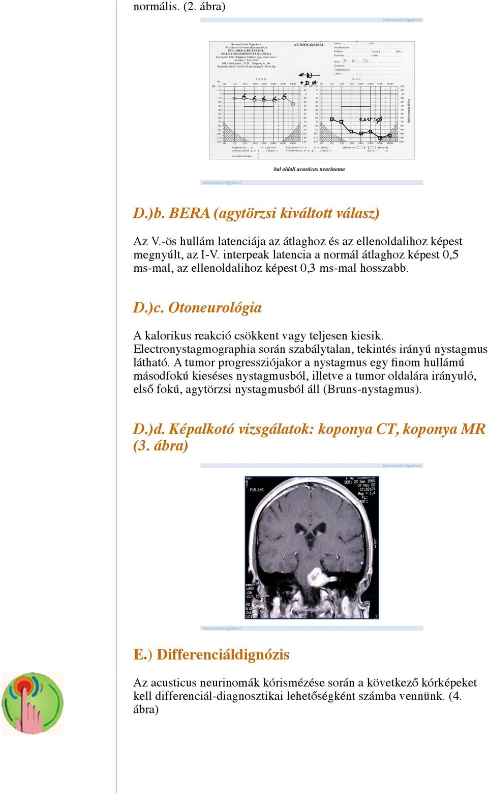 Electronystagmographia során szabálytalan, tekintés irányú nystagmus látható.