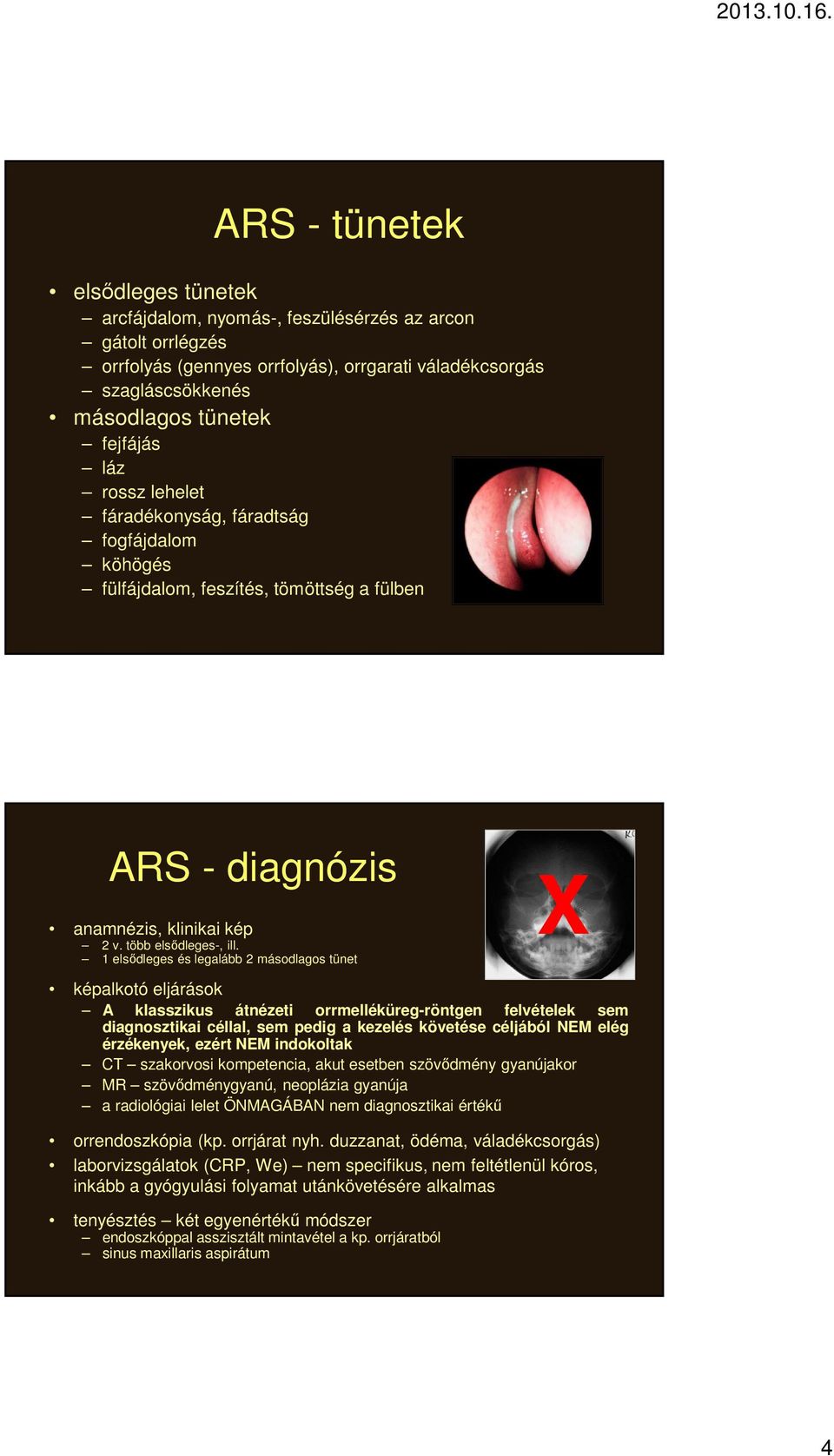 Szinuszitiszek, endoszkópos melléküreg-sebészet (ESS) - PDF Free Download