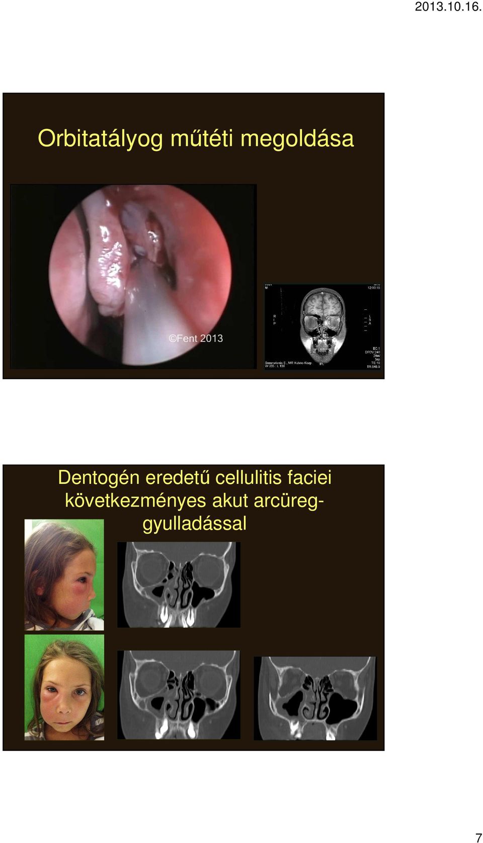 cellulitis faciei