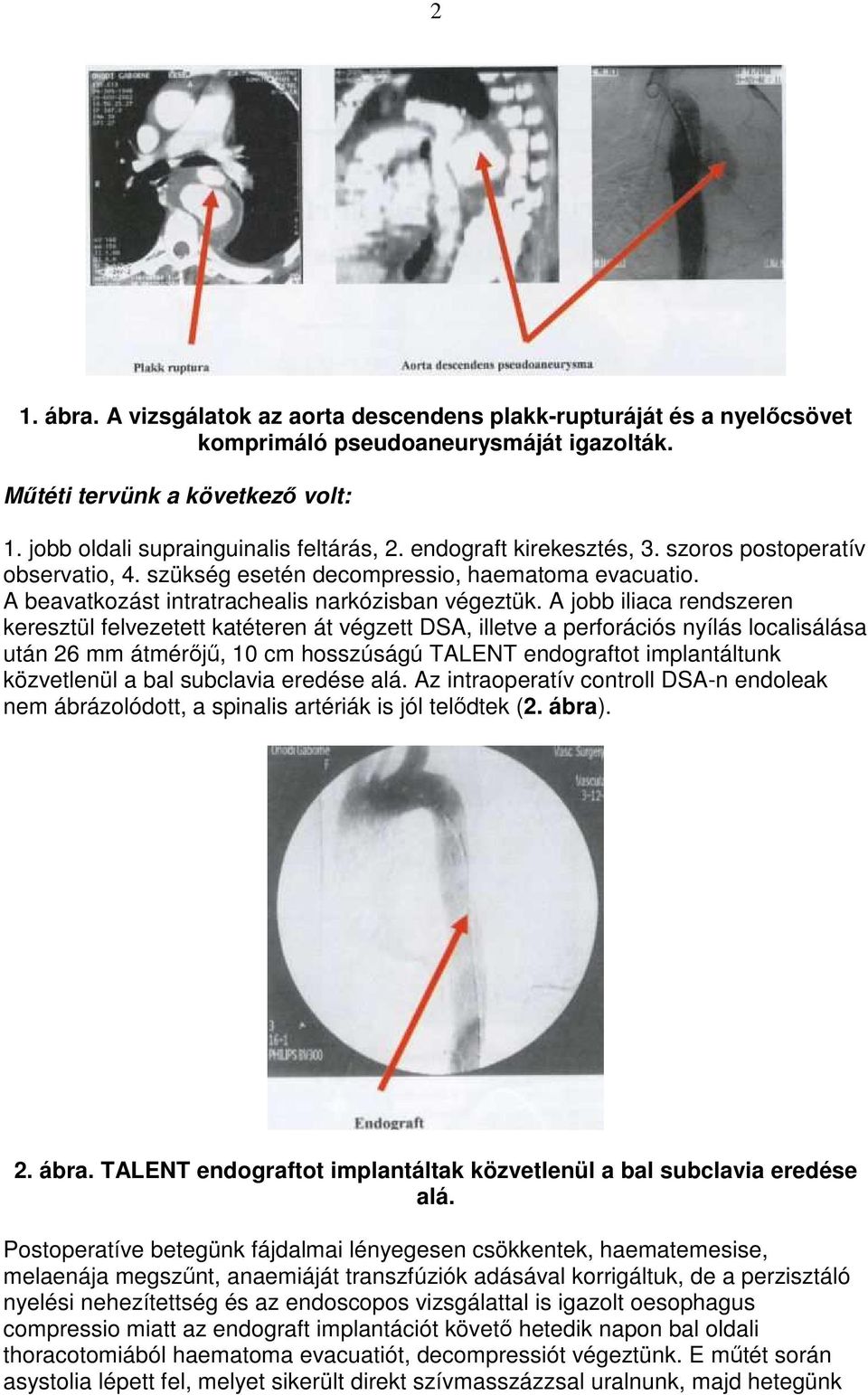 A jobb iliaca rendszeren keresztül felvezetett katéteren át végzett DSA, illetve a perforációs nyílás localisálása után 26 mm átmérıjő, 10 cm hosszúságú TALENT endograftot implantáltunk közvetlenül a