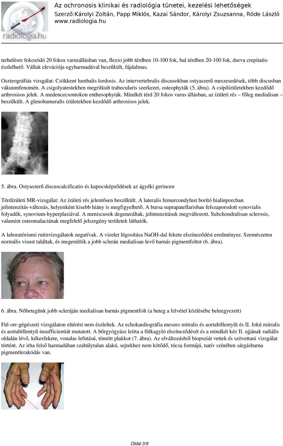 A csigolyatestekben megritkult trabecularis szerkezet, osteophyták (5. ábra). A csípőízületekben kezdődő arthrosisos jelek. A medencecsontokon enthesophyták.