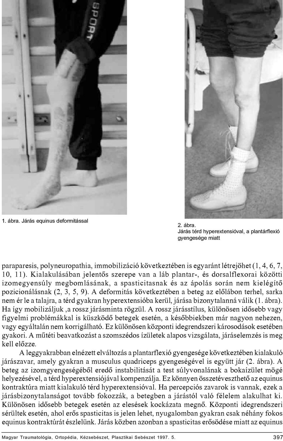 A deformitás következtében a beteg az elôlábon terhel, sarka nem ér le a talajra, a térd gyakran hyperextensióba kerül, járása bizonytalanná válik (1. ábra).