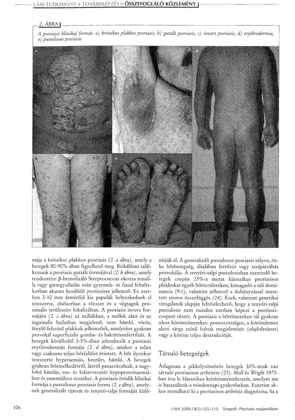 a ábra), amely a betegek 80-90%-ában figyelhető meg. Ritkábban talál kozunk a psoriasis guttált formájával (2.