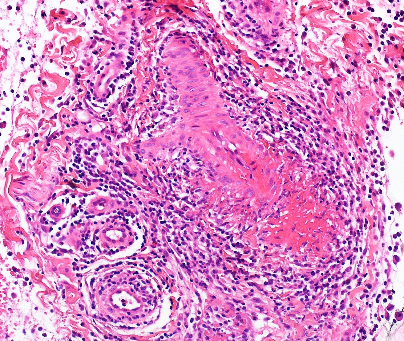 Polyarteritis nodosa: az