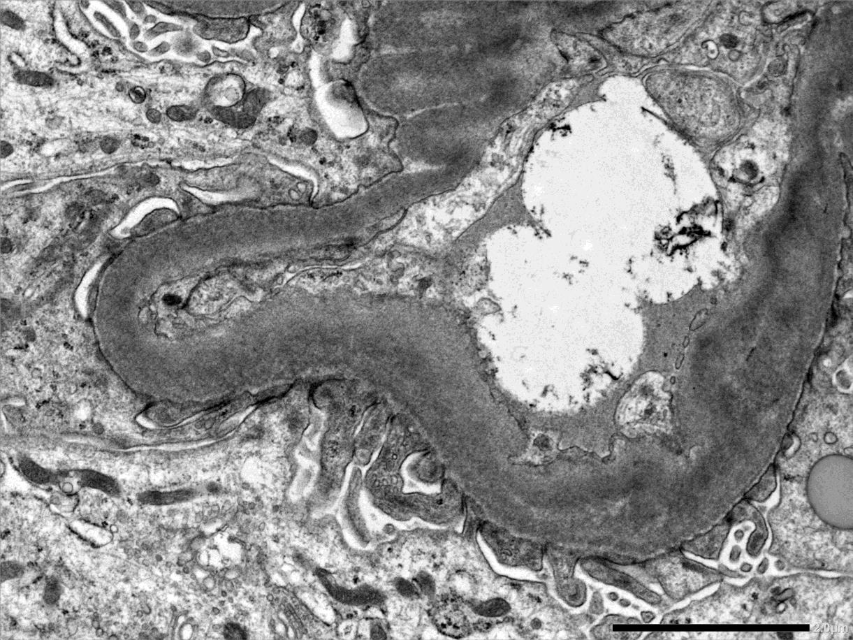 Könnyűlánc betegség: a glomeruláris és