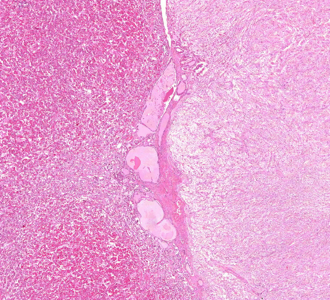 Pars intermedia: eosinophyl kolloiddal telt kicsi, follikulus-