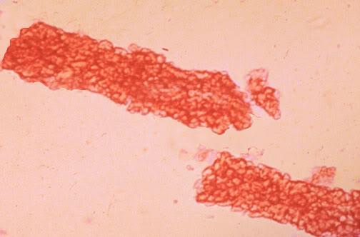 proteinanalízis Haematuria