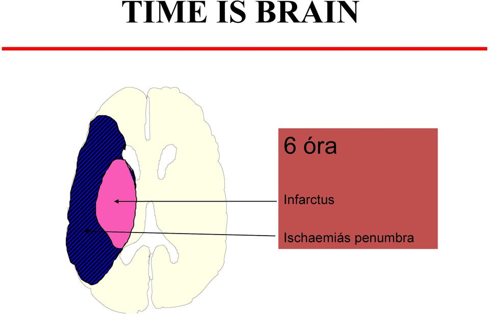 Infarctus