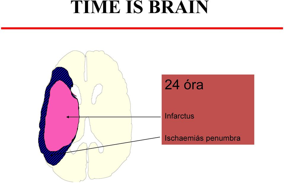 Infarctus