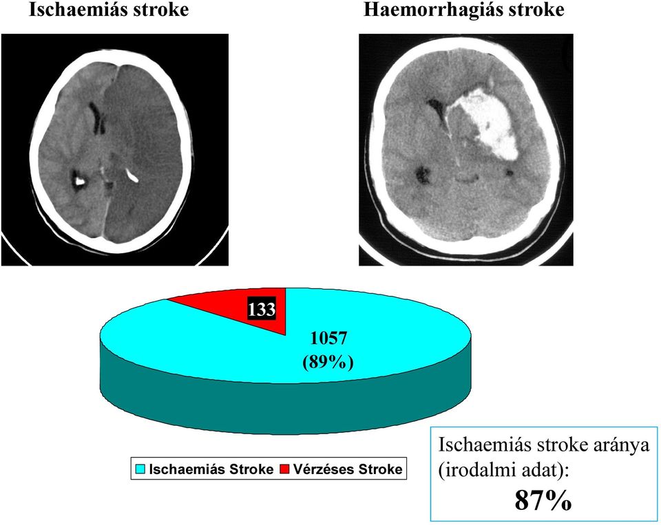 Stroke Vérzéses Stroke Ischaemiás