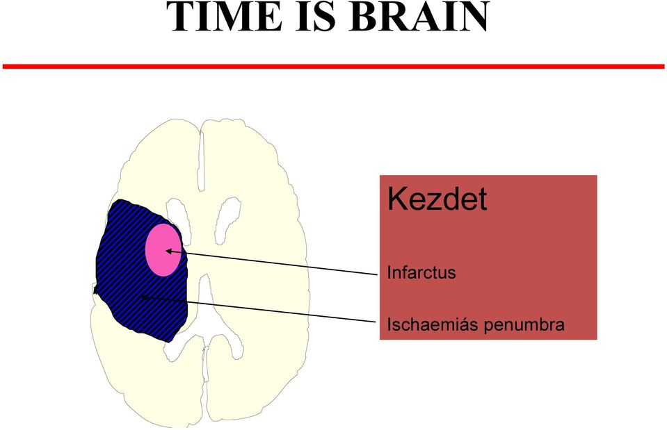 Infarctus